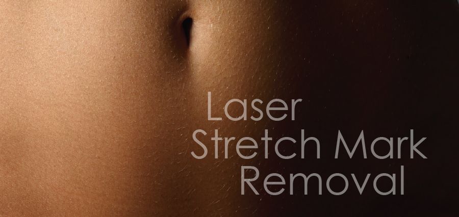 Laser Stretch Mark Removal  Eternal Skin Care